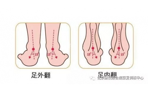 矫形鞋垫的作用