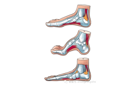 足弓不正常危害有多大？你想象不到…