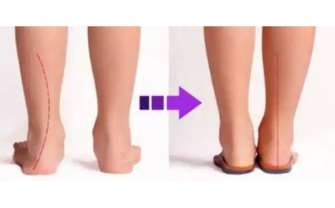 矫形鞋垫和普通鞋垫的区别在哪？