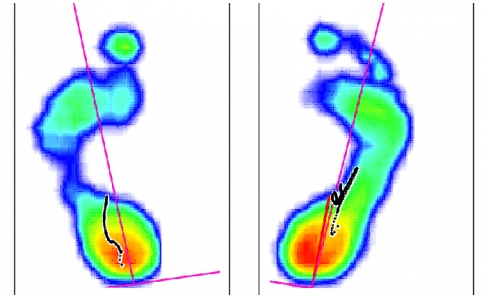 病理足的足底压力特征
