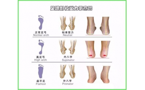 常见足部病变的矫形鞋垫康复与护理（一）