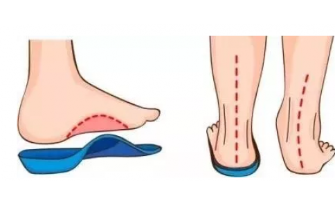 矫形鞋垫为啥都走 