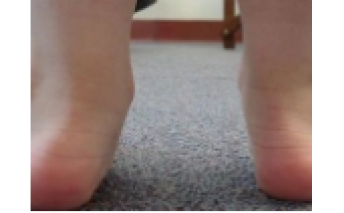 话题讨论-儿童扁平足是否需要矫形处理？