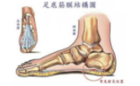 扁平足的矫形治疗——儿童与成人基本原则大有不同