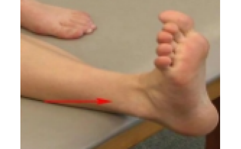 崴脚不是小事！足踝扭伤的预防和保护你必须知道！