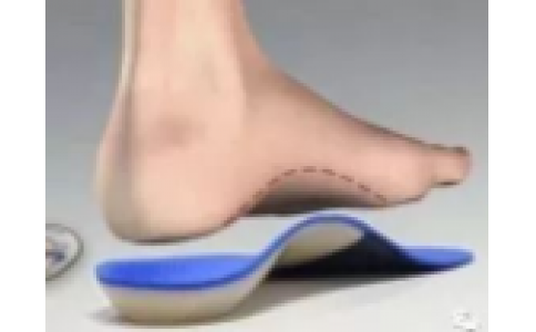 穿戴矫形鞋垫，就是一种治疗